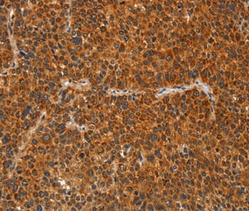 Immunohistochemical analysis of paraffin-embedded Human liver cancer tissue using #36254 at dilution 1/60.