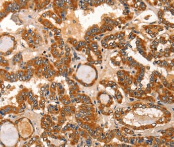 Immunohistochemical analysis of paraffin-embedded Human thyroid cancer tissue using #36254 at dilution 1/60.