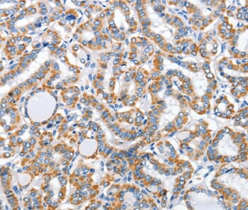 Immunohistochemical analysis of paraffin-embedded Human thyroid cancer tissue using #36261 at dilution 1/30.