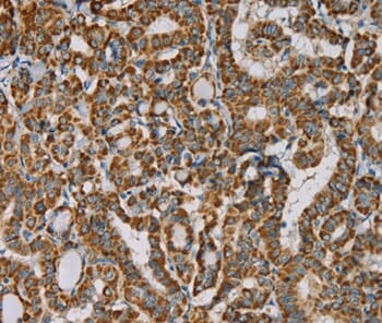 Immunohistochemical analysis of paraffin-embedded Human thyroid cancer tissue using #36554 at dilution 1/25.