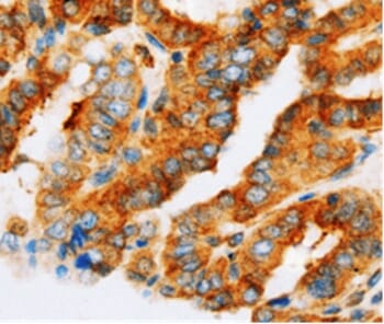 Immunohistochemical analysis of paraffin-embedded Human thyroid cancer tissue using #36741 at dilution 1/55.