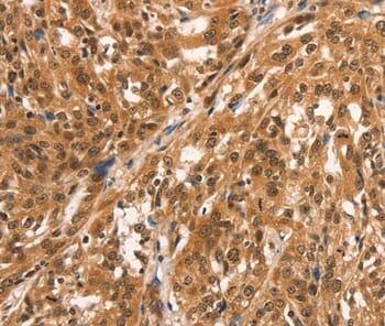 Immunohistochemical analysis of paraffin-embedded Human oesophagus cancer tissue using #36821 at dilution 1/25.