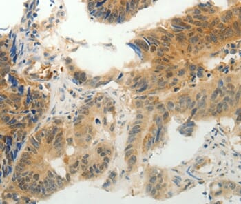 Immunohistochemical analysis of paraffin-embedded Human colon cancer tissue using #36884 at dilution 1/30.