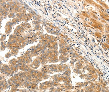 Immunohistochemical analysis of paraffin-embedded Human liver cancer tissue using #37063 at dilution 1/25.