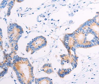 Immunohistochemical analysis of paraffin-embedded Human colon cancer tissue using #37100 at dilution 1/15.
