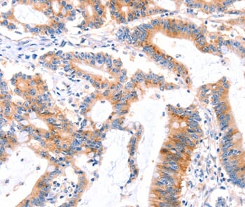 Immunohistochemical analysis of paraffin-embedded Human colon cancer tissue using #37144 at dilution 1/30.