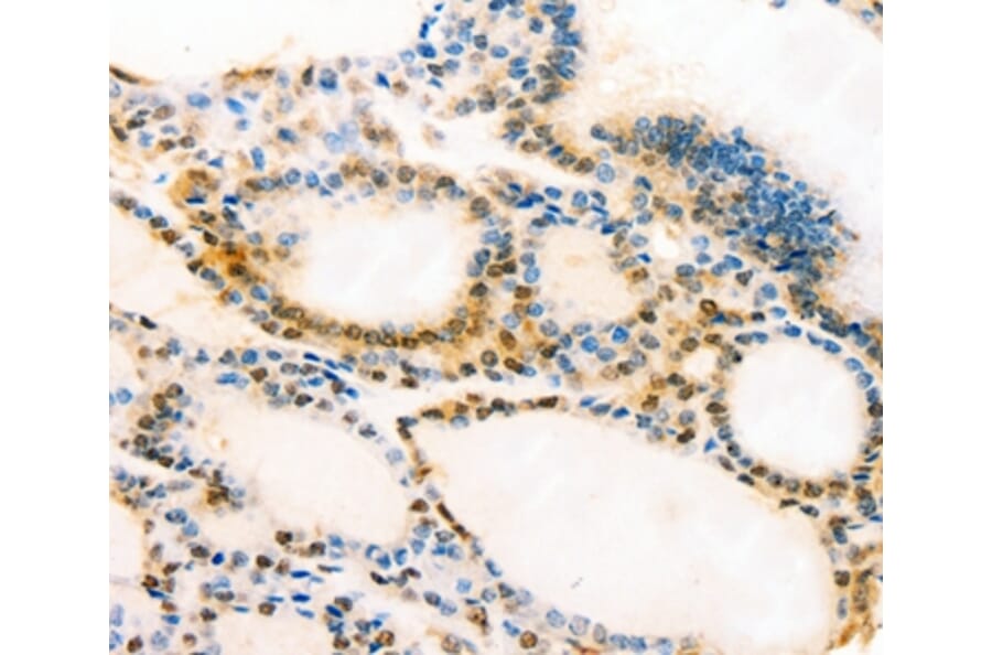 Immunohistochemistry - MUC16 Antibody from Signalway Antibody (37173) - Antibodies.com