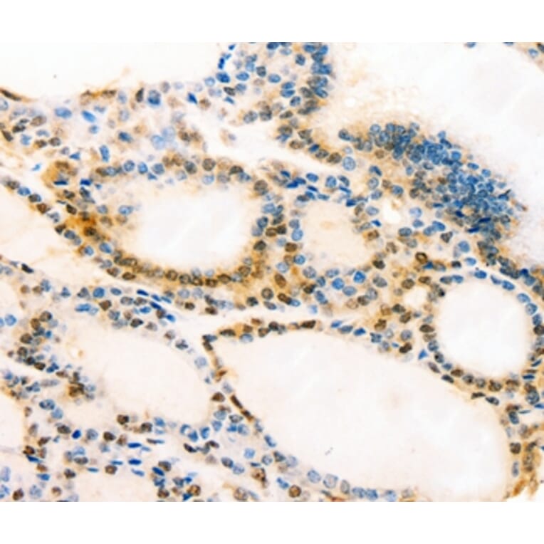 Immunohistochemistry - MUC16 Antibody from Signalway Antibody (37173) - Antibodies.com