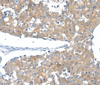 Immunohistochemical analysis of paraffin-embedded Human breast cancer tissue using #37258 at dilution 1/40.