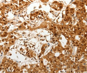 Immunohistochemical analysis of paraffin-embedded Human ovarian cancer tissue using #37270 at dilution 1/50.