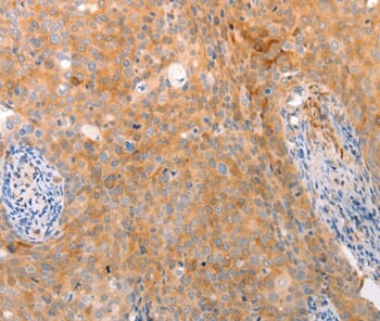 Immunohistochemical analysis of paraffin-embedded Human cervical cancer tissue using #37304 at dilution 1/50.