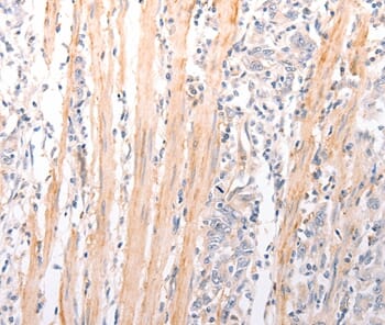 Immunohistochemical analysis of paraffin-embedded Human gastric cancer tissue using #37304 at dilution 1/50.