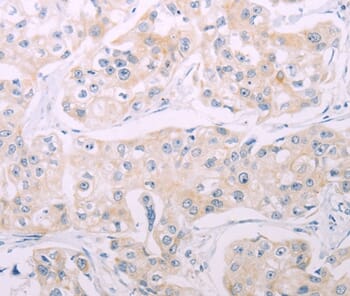 Immunohistochemical analysis of paraffin-embedded Human breast cancer tissue using #37316 at dilution 1/60.