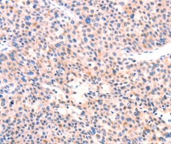 Immunohistochemical analysis of paraffin-embedded Human liver cancer tissue using #37336 at dilution 1/80.