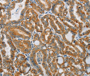 Immunohistochemical analysis of paraffin-embedded Human thyroid cancer tissue using #37364 at dilution 1/15.