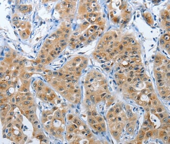 Immunohistochemical analysis of paraffin-embedded Human lung cancer tissue using #37367 at dilution 1/35.