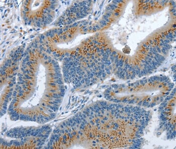 Immunohistochemical analysis of paraffin-embedded Human colon cancer tissue using #37367 at dilution 1/35.