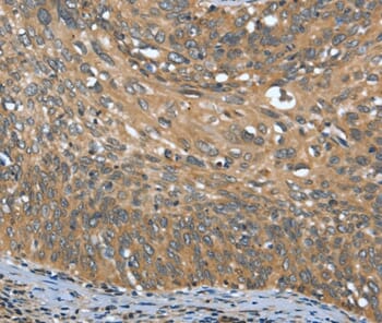 Immunohistochemical analysis of paraffin-embedded Human cervical cancer tissue using #37527 at dilution 1/20.