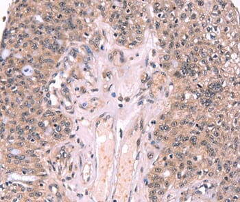 Immunohistochemical analysis of paraffin-embedded Human ovarian cancer tissue using #37561 at dilution 1/20.