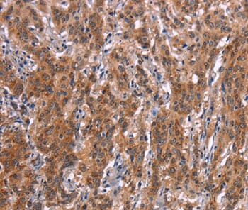 Immunohistochemical analysis of paraffin-embedded Human gastric cancer tissue using #37568 at dilution 1/25.
