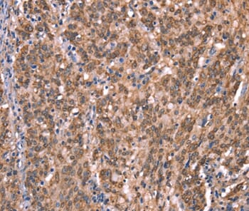 Immunohistochemical analysis of paraffin-embedded Human gastric cancer tissue using #37588 at dilution 1/40.