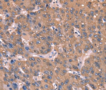 Immunohistochemical analysis of paraffin-embedded Human liver cancer tissue using #37588 at dilution 1/40.