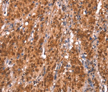 Immunohistochemical analysis of paraffin-embedded Human gastric cancer tissue using #37593 at dilution 1/20.