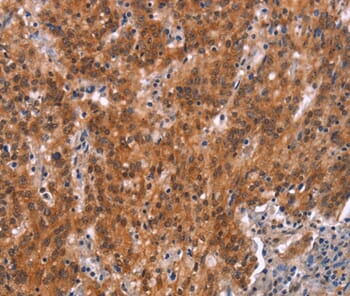 Immunohistochemical analysis of paraffin-embedded Human gastric cancer tissue using #37600 at dilution 1/15.