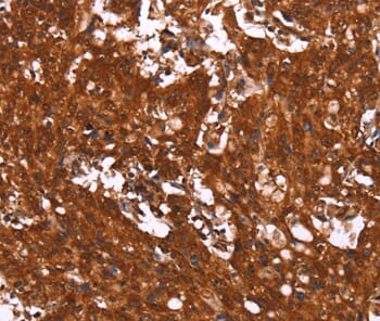 Immunohistochemical analysis of paraffin-embedded Human gastric cancer tissue using #37602 at dilution 1/40.
