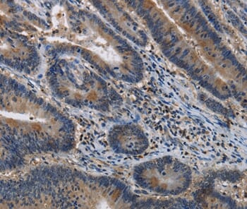 Immunohistochemical analysis of paraffin-embedded Human colon cancer tissue using #37666 at dilution 1/40.