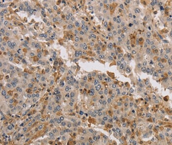 Immunohistochemical analysis of paraffin-embedded Human liver cancer tissue using #37683 at dilution 1/40.