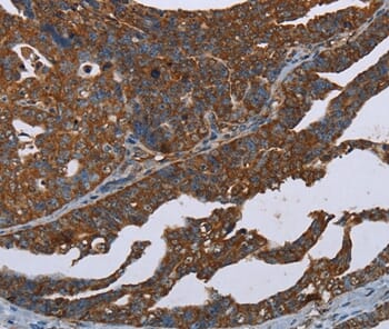 Immunohistochemical analysis of paraffin-embedded Human ovarian cancer tissue using #37695 at dilution 1/20.