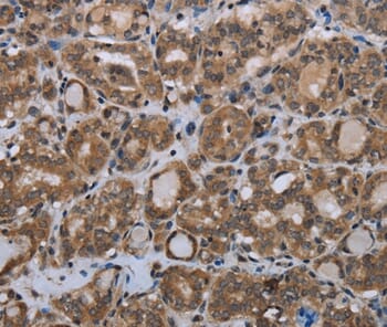 Immunohistochemical analysis of paraffin-embedded Human thyroid cancer tissue using #37744 at dilution 1/20.