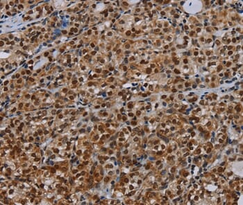 Immunohistochemical analysis of paraffin-embedded Human thyroid cancer tissue using #37778 at dilution 1/30.