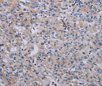 Immunohistochemical analysis of paraffin-embedded Human prostate cancer tissue using #37793 at dilution 1/40.