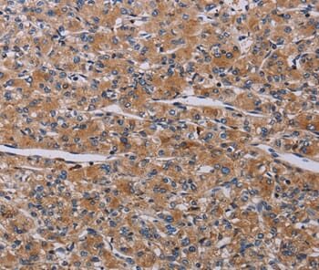 Immunohistochemical analysis of paraffin-embedded Human prostate cancer tissue using #37796 at dilution 1/20.