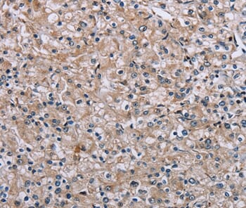 Immunohistochemical analysis of paraffin-embedded Human prostate cancer tissue using #37831 at dilution 1/40.