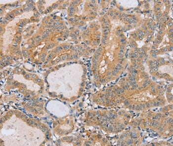 Immunohistochemical analysis of paraffin-embedded Human thyroid cancer tissue using #37851 at dilution 1/40.