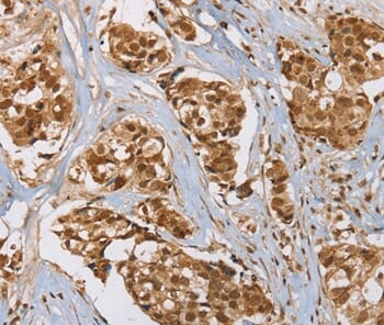 Immunohistochemical analysis of paraffin-embedded Human breast cancer tissue using #37859 at dilution 1/45.