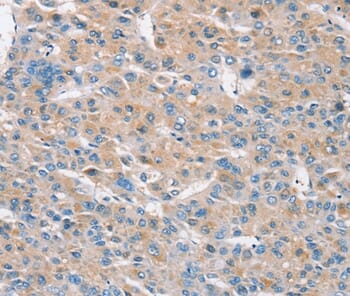Immunohistochemical analysis of paraffin-embedded Human liver cancer tissue using #37862 at dilution 1/30.