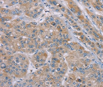 Immunohistochemical analysis of paraffin-embedded Human liver cancer tissue using #37891 at dilution 1/35.