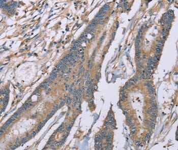 Immunohistochemical analysis of paraffin-embedded Human colorectal cancer tissue using #37895 at dilution 1/20.
