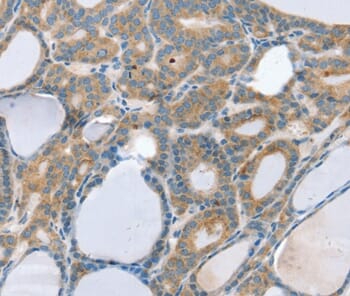 Immunohistochemical analysis of paraffin-embedded Human thyroid cancer tissue using #37966 at dilution 1/20.