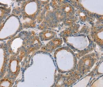 Immunohistochemical analysis of paraffin-embedded Human thyroid cancer tissue using #37967 at dilution 1/20.