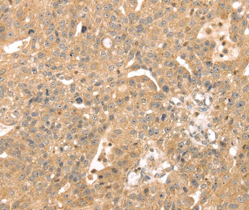 Immunohistochemical analysis of paraffin-embedded Human breast cancer tissue using #40087 at dilution 1/30.