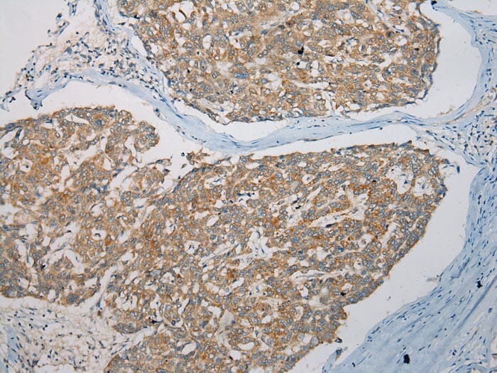 Immunohistochemical analysis of paraffin-embedded Human Liver cancer tissue using #40113 at dilution 1/100.