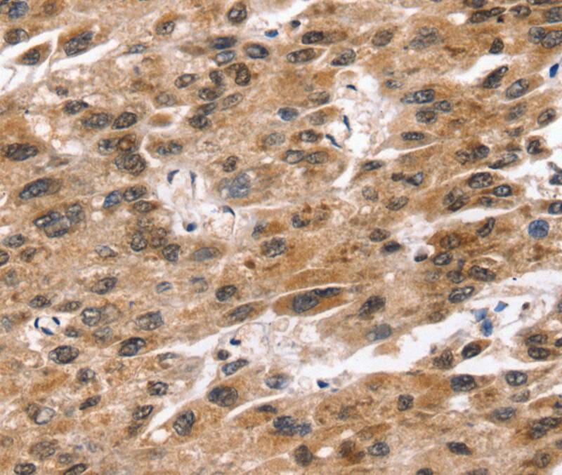 Immunohistochemical analysis of paraffin-embedded Human liver cancer tissue using #40233 at dilution 1/20.