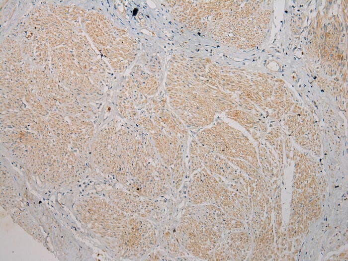 Immunohistochemical analysis of paraffin-embedded Human Prostate cancer tissue using #40270 at dilution 1/100.