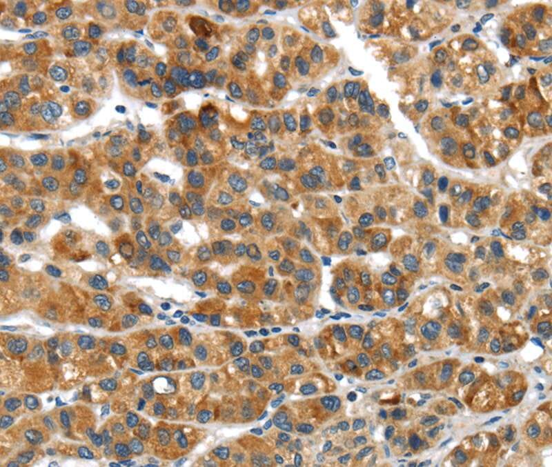 Immunohistochemical analysis of paraffin-embedded Human liver cancer tissue using #40276 at dilution 1/20.