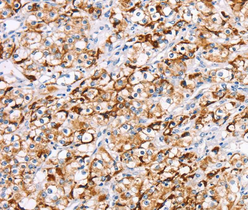 Immunohistochemical analysis of paraffin-embedded Human prostate cancer tissue using #40320 at dilution 1/20.